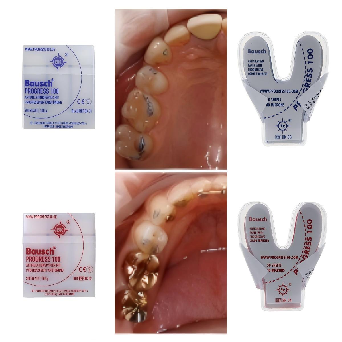 Bausch BK51 BK52 BK53 BK54 Den – Bite Indicator recenzja i cena